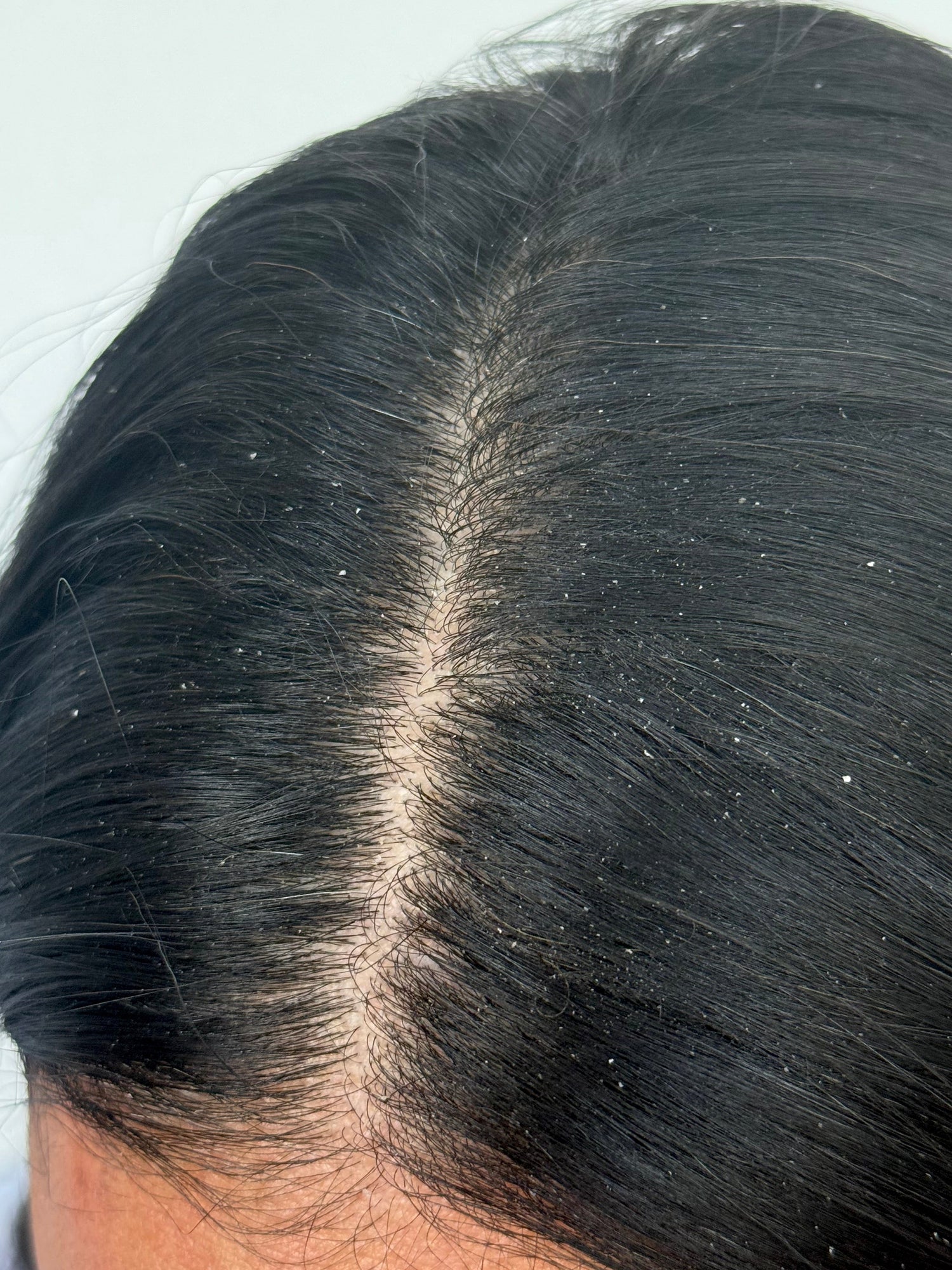 Close-up of a person's head with dark hair and visible dandruff.